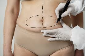 Abdominoplastia: guía de recuperación semana a semana