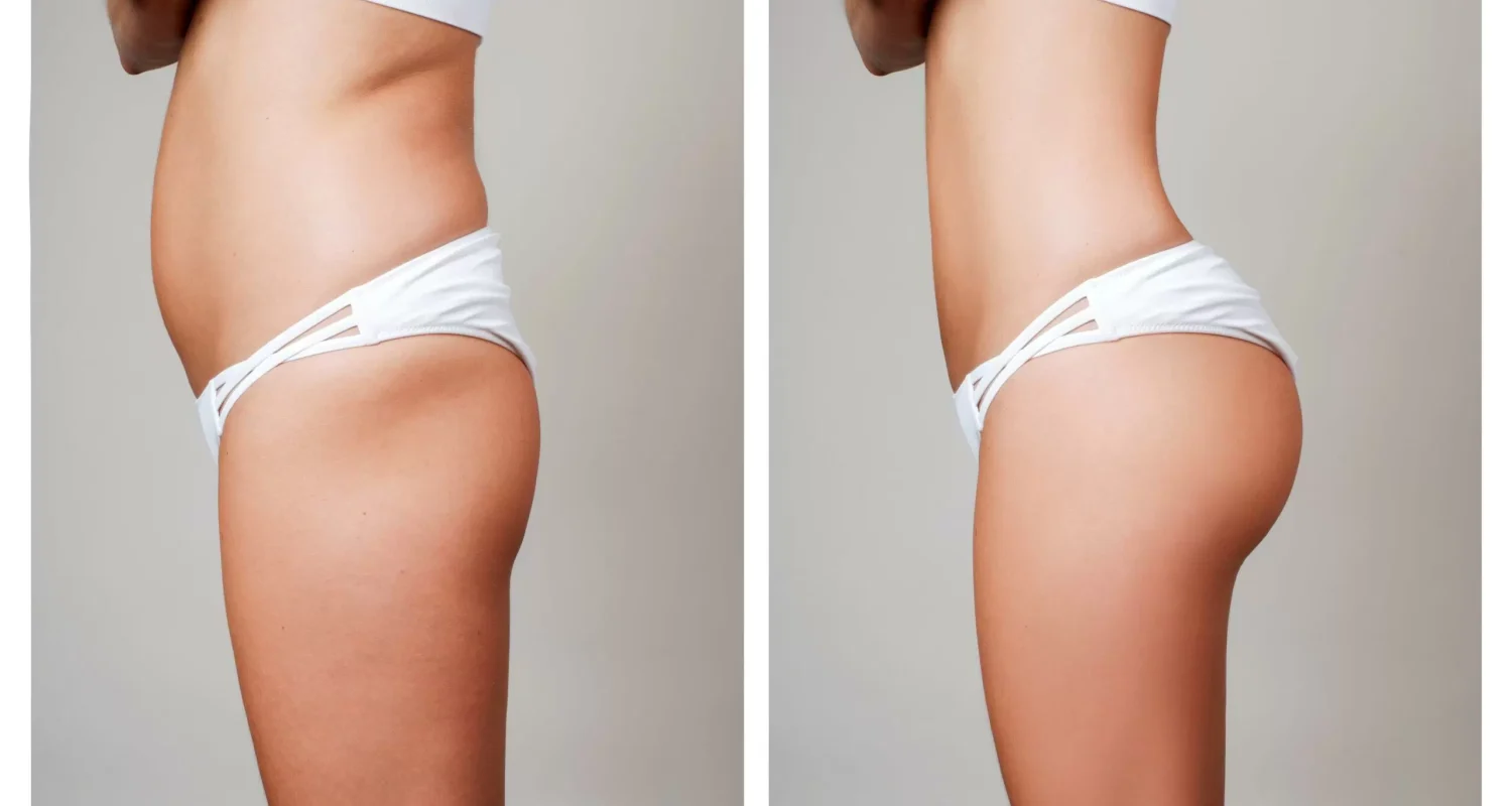 Lipoescultura con transferencia a glúteos