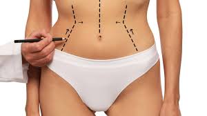 Liposucción: qué zonas se pueden tratar y qué resultados esperar