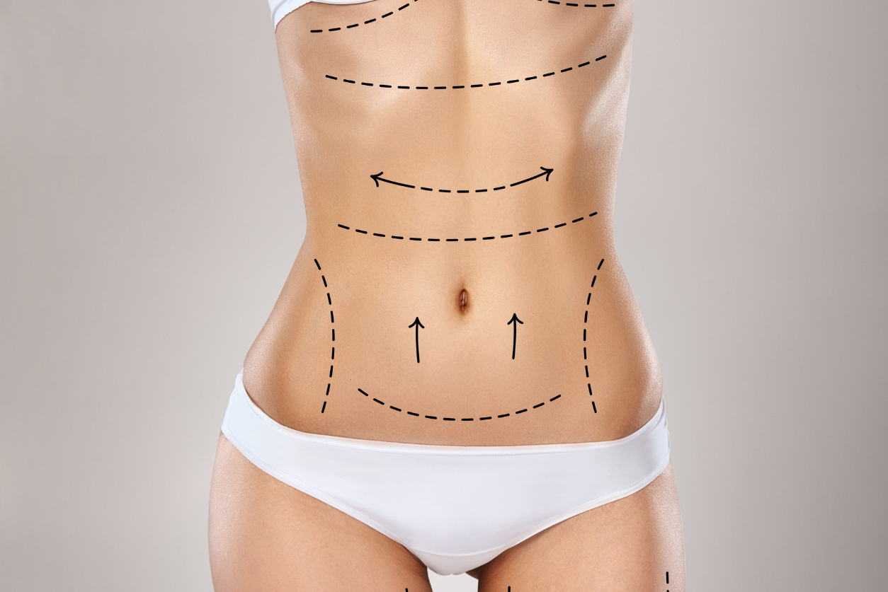 Resultado visual relacionado con Liposucción