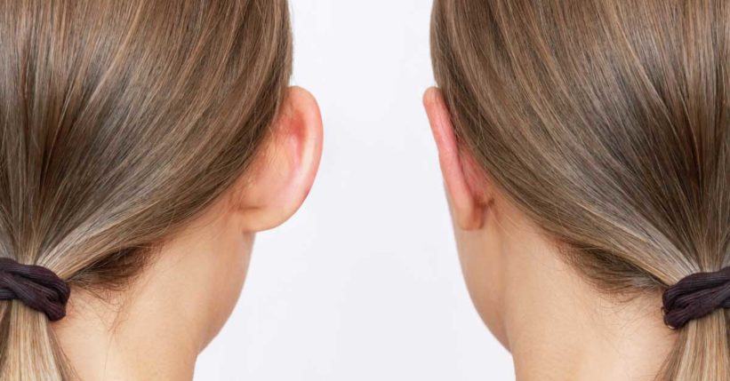 Resultado visual relacionado con Otoplastia